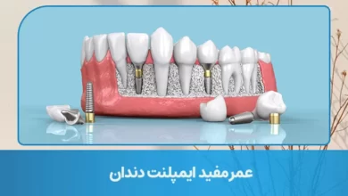 useful life dental implants markazlabkhand.webp.webp عمر مفید ایمپلنت دندان چقدر است؟