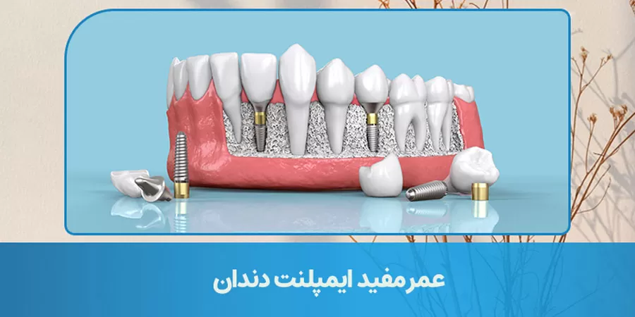 useful life dental implants markazlabkhand.webp.webp عمر مفید ایمپلنت دندان چقدر است؟